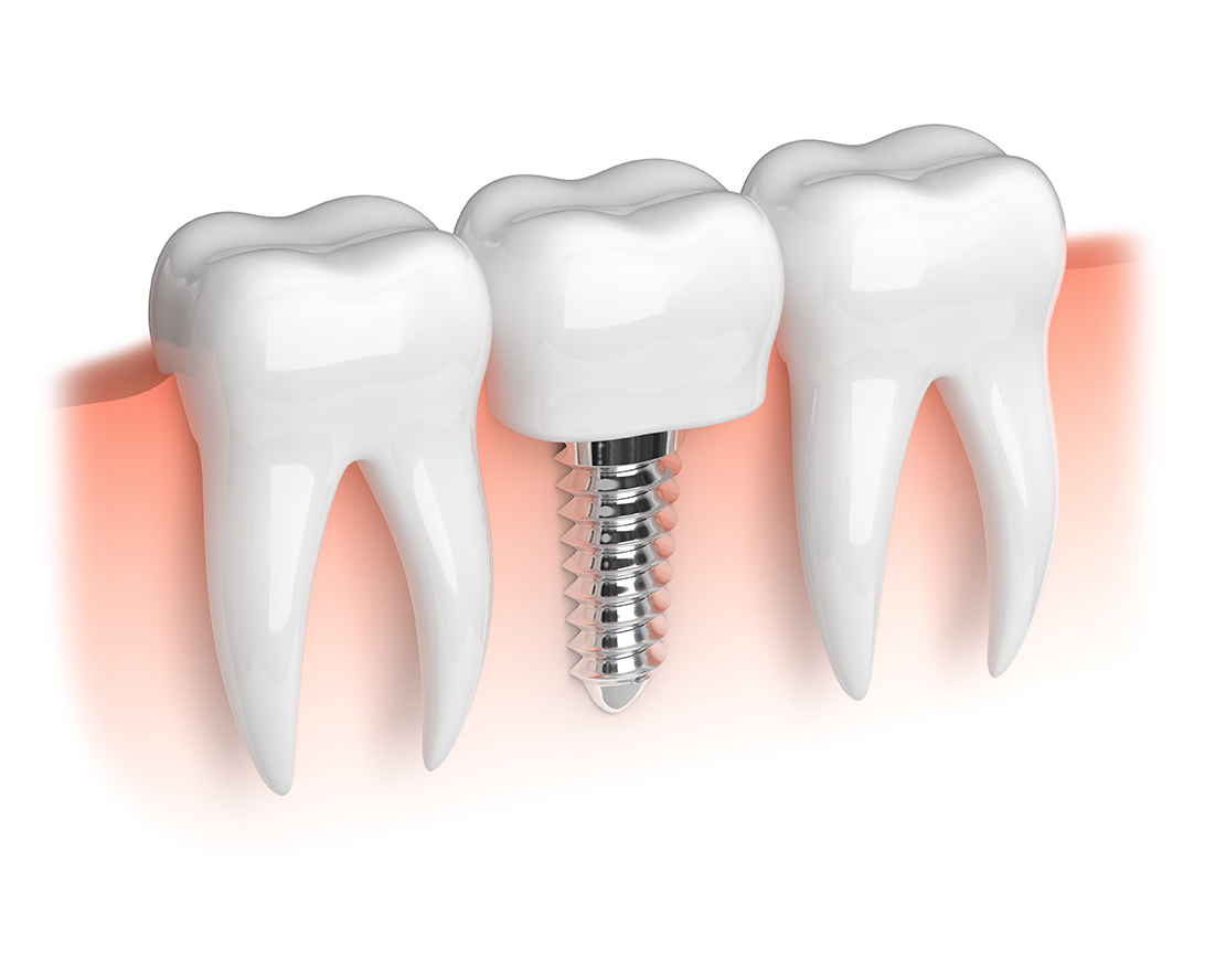 Diamond On Permanent Teeth